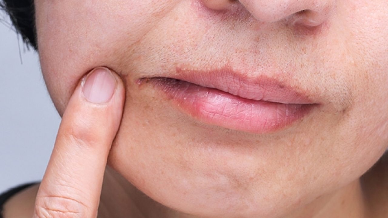 Fungal Lip Infection -Prevention And Home Cures